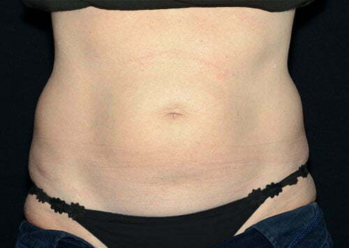 coolsculpting-02a-before-samaha