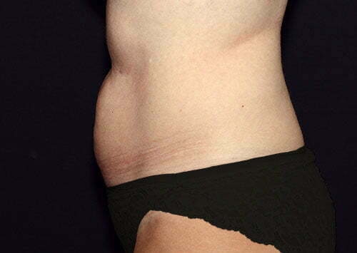 CoolSculpting