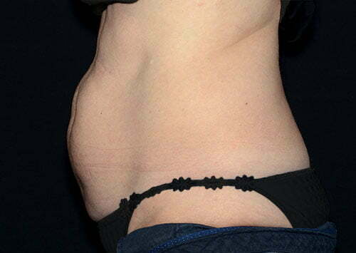 CoolSculpting