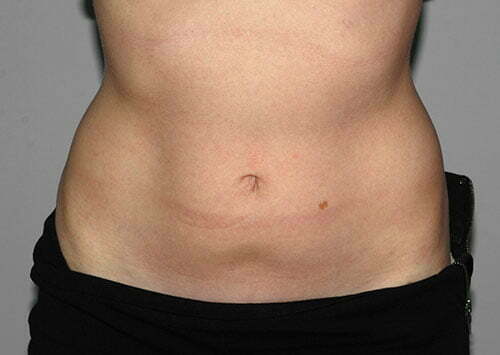 CoolSculpting