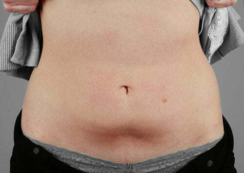 CoolSculpting