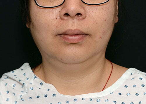 CoolSculpting