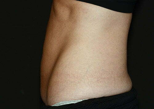 CoolSculpting Patient