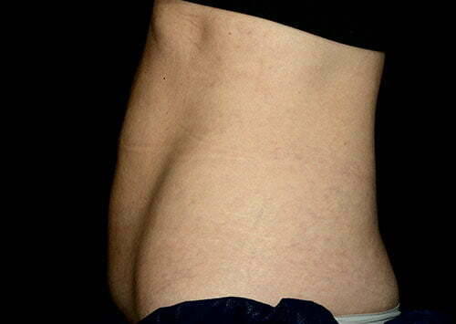CoolSculpting Patient