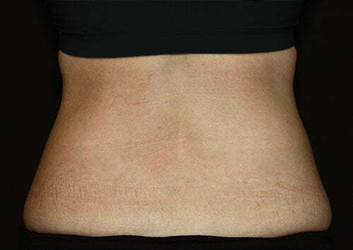 coolsculpting-flanks-14444d-after-samaha