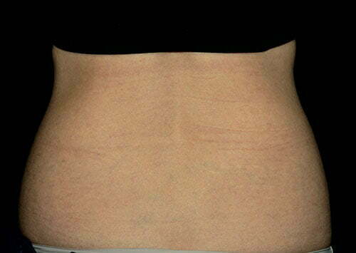 coolsculpting-flanks-14444d-before-samaha