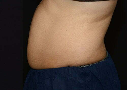 CoolSculpting Patient