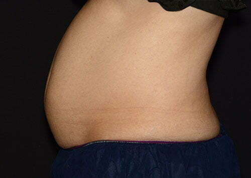 CoolSculpting Patient