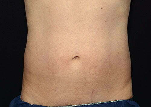 CoolSculpting Patient