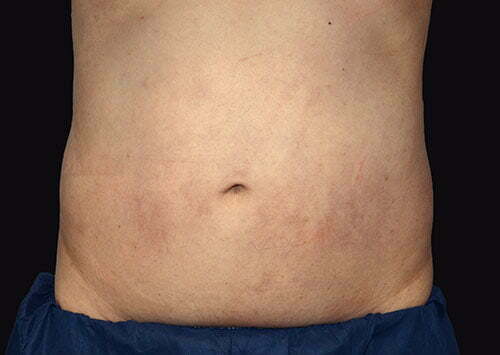 CoolSculpting Patient