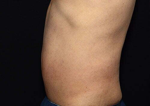 coolsculpting-lower-abdomen-flanks-14452c-after-samaha