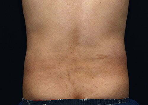 coolsculpting-lower-abdomen-flanks-14452d-after-samaha