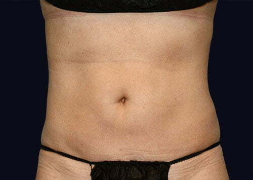 coolsculpting-upper-abdomen-14466a-after-samaha