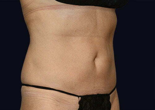 coolsculpting-upper-abdomen-14466b-after-samaha