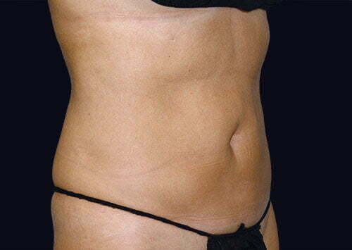 coolsculpting-upper-abdomen-14466b-before-samaha