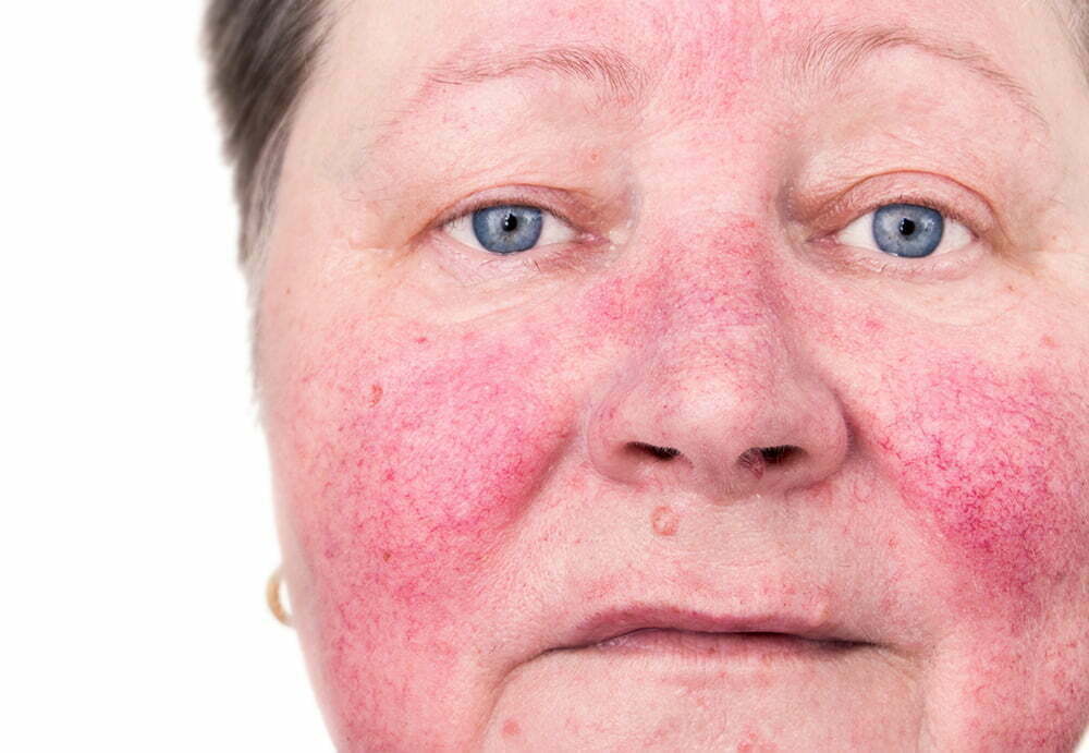 woman with redness across her cheeks and nose, symptoms of rosacea