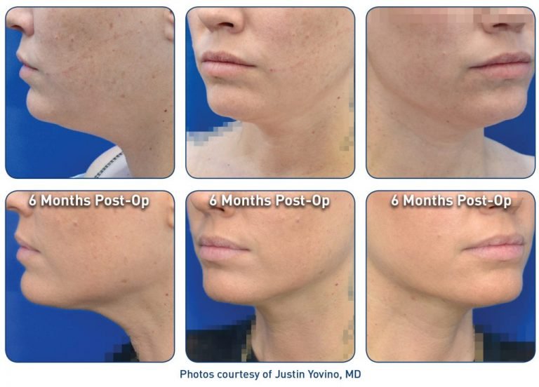 Renuvion Skin Tightening