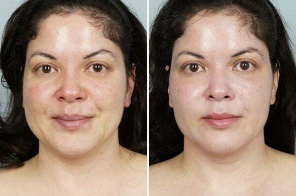 CoolPeel Before and After Patient