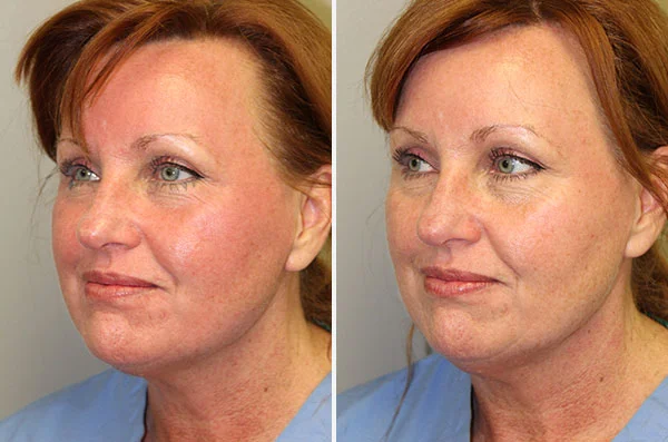 CoolPeel - Boston Plastic Surgery