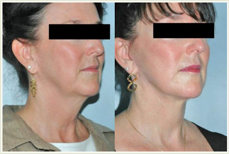 Facelift Before and After image showing reduced jowls, improved neckline, firm jawline, and healthy skin