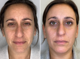 Before and after Elluminate laser treatments