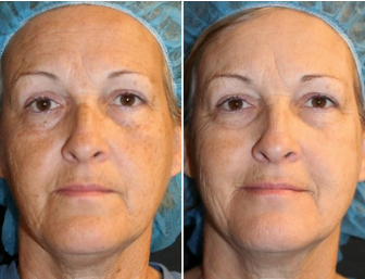 Before and after Elluminate laser treatments