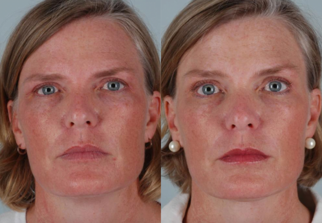 Photo of patient after Botox treatment