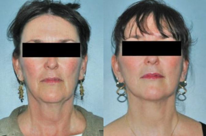 Facelift patient front view showing natural results, improved neck line and improved skin