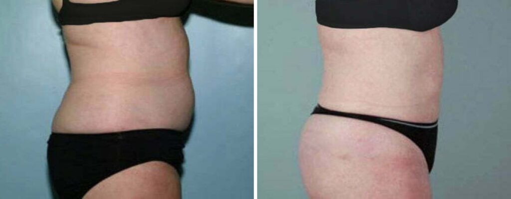 Photo of a patient before and after liposuction. Lipo is commonly performed with a body lift procedure, arm lift procedure, and thigh lift procedure to remove fat from the body. Use our menu options to learn what procedures are offered. 