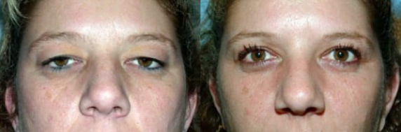 Real eyelid lift patient shown before and after cosmetic blepharoplasty