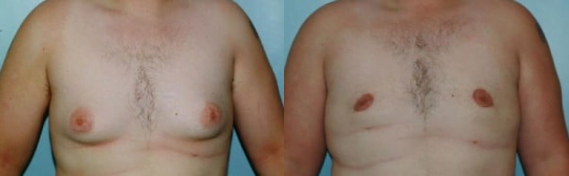 Before and after gynecomastia surgery for male breast reduction with Boston plastic surgeon Dr. Samaha