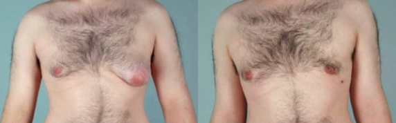 Real patient with asymmetrical gynecomastia before and after male breast reduction with Boston plastic surgeon Dr. Samaha