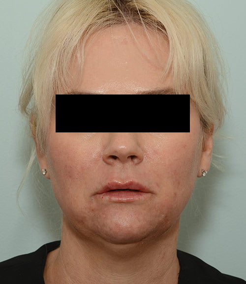 Restylane Kysse