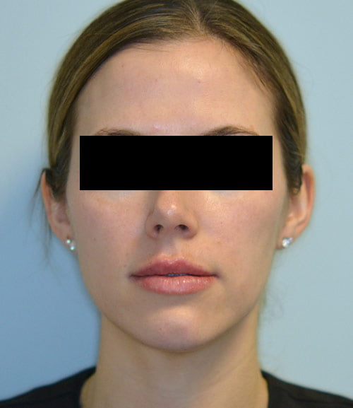 Restylane Kysse