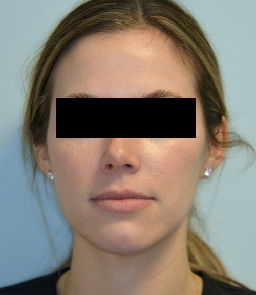Restylane Kysse