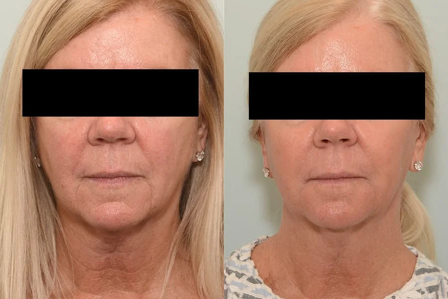 Patient before and after CoolPeel and Sofwave