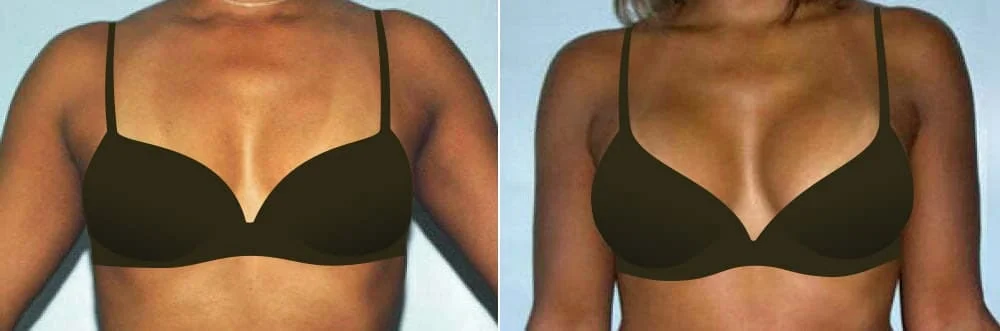 Before and after breast augmentation with Boston plastic surgeon Dr. Fouad Samaha