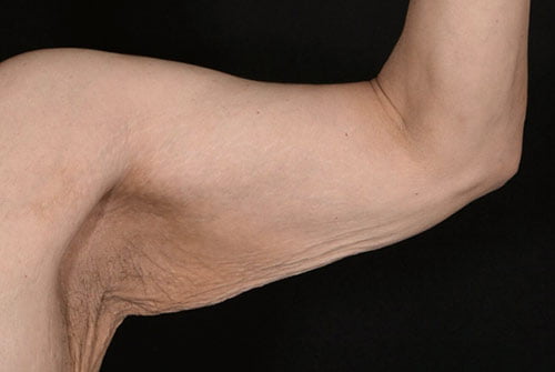 Male Arm Lift