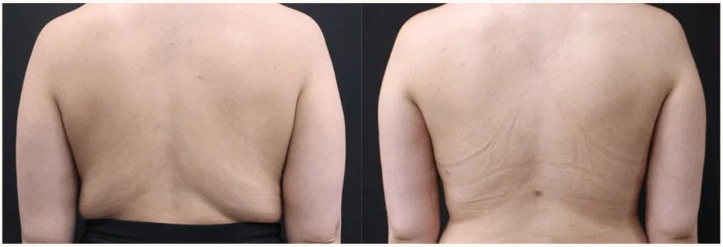 Before and after back liposuction in Boston