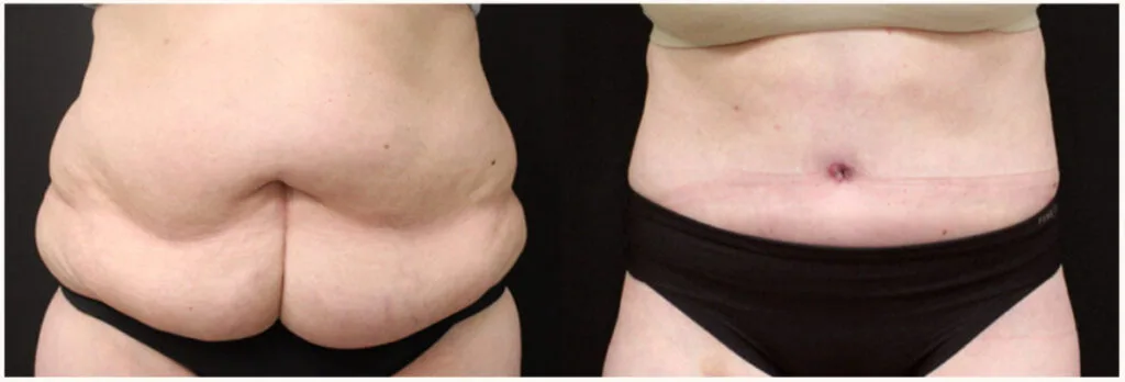 Before and after Boston tummy tuck with 360 lipo