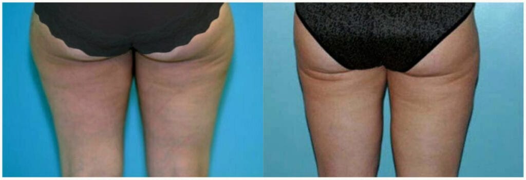 Before and after Boston liposuction for flanks and thighs