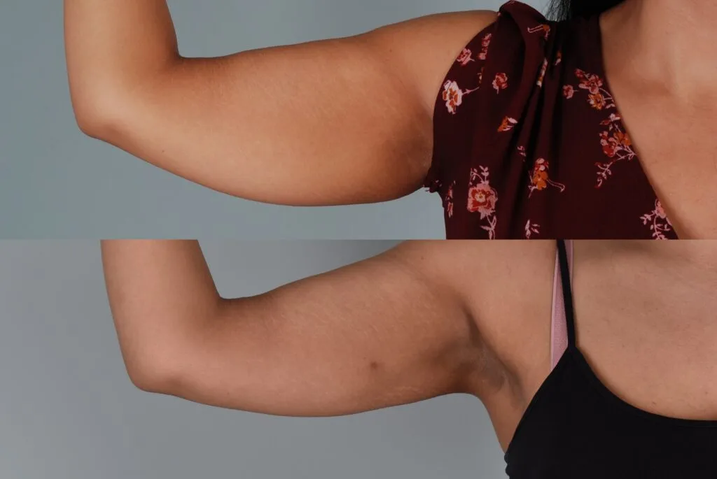 Non-surgical arm lift with Renuvion at Boston Plastic Surgery