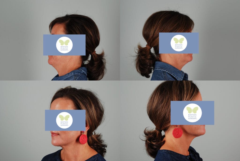 Before and after Renuvion non-surgical skin tightening at Boston Plastic Surgery