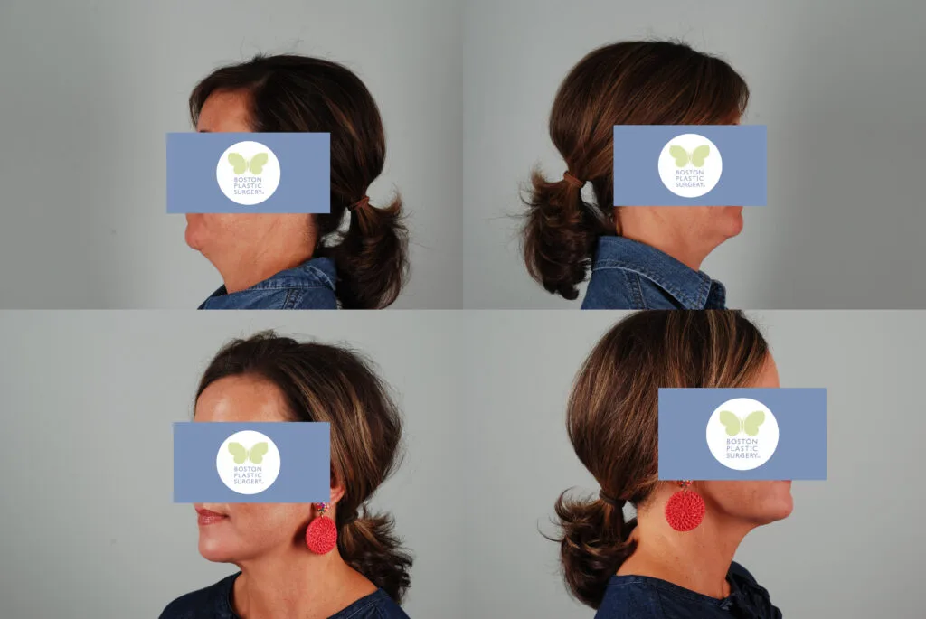 Before and after Renuvion non-surgical skin tightening at Boston Plastic Surgery